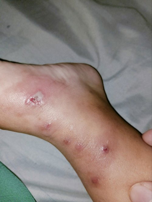 Kulit gatal lalu luka