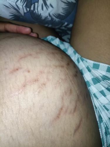 Stretch Marks