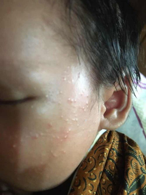 muka bayi beruntusan