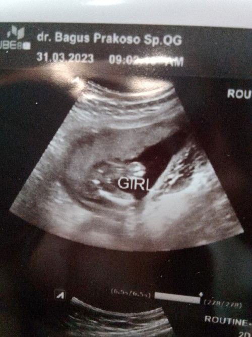 Hasil USG anak perempuan