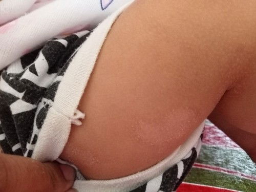 แม่ๆๆบ้านไหนลูกเป็นเหมือนด่างทีขาและลำตัวแขนด้วยค้ะช่วยแนะนำหน่อยค้ะว่าลูกแพ้อะไรหรือป่าว