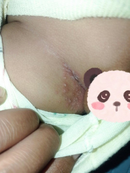 Ruam atau apa?