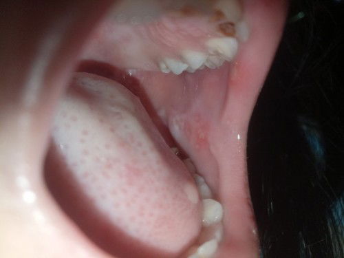 Obat mulut dan tangan