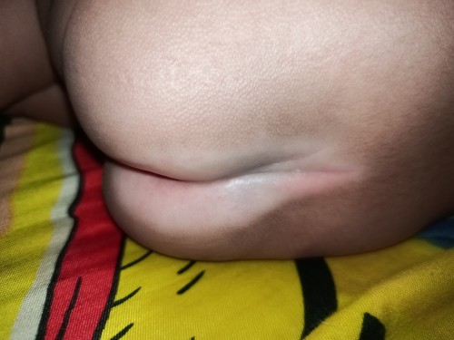 Normal lang po tong pwet ni baby bat kaya ganito