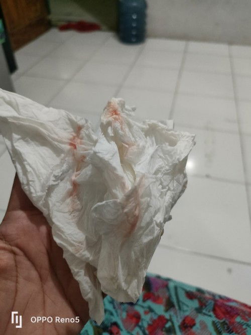 Bund tolong dijawab ya  udah seminggu ini saya bapil,batuknya mpeg ngiklik sekali