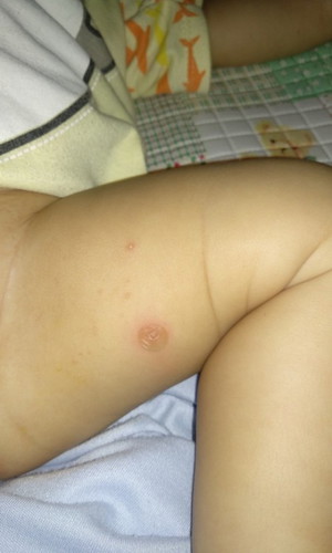 Ini kenapa ya anak saya tiba" keluar bentol kaya berair gini ada yang sama gak bund