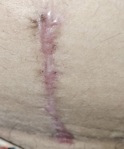 Tahi cesarean