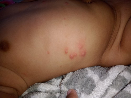 Bentol di badan bayi