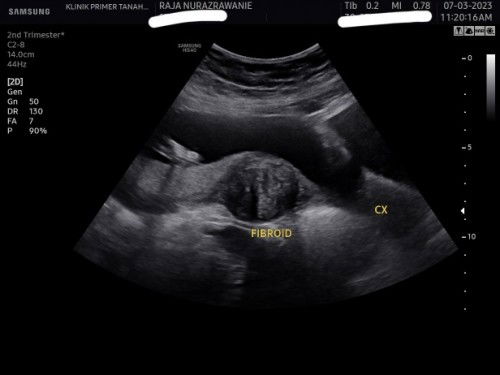 FIBROID MASA PREGNANT