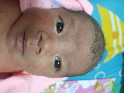 ผื่นขึ้นหน้า และ หน้าอก