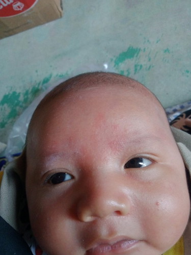 mau tanya bun. bintik putih dijidat