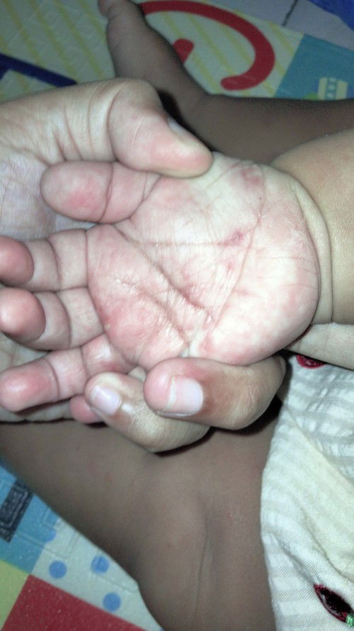 Telapak tangan Dan telapak kaki gatal