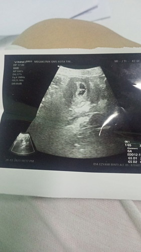 Sya pregnant 4weeks aritu scan doktor ckp kantung baby bentuk bujur ada x sapa pengalaman mcm saya..