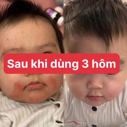 KEM BÔI DA THẢO DƯỢC