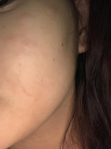 Normal lang po ba ang pantal pantal sa 35weeks pregy