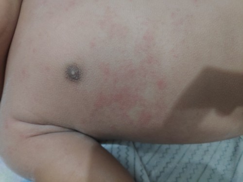 Bun bantu jawab dong ini kenapa ya, badan anaku merah2 gini ?? Gak tega liatnya