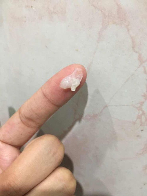 ตกขาวใช่ไหมค่ะ