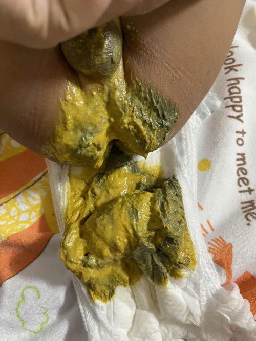 Phân bé 6th rưỡi