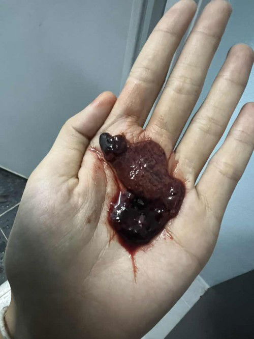 มีก้อนเลือดหลุดออกขณะตั้งครรภ์ได้ 1เดือน