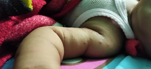 Barangkali ada yg Pernah ngalamin . bayiku gatel sebadan, nular serumah. Kira2 obat nya apa ya?