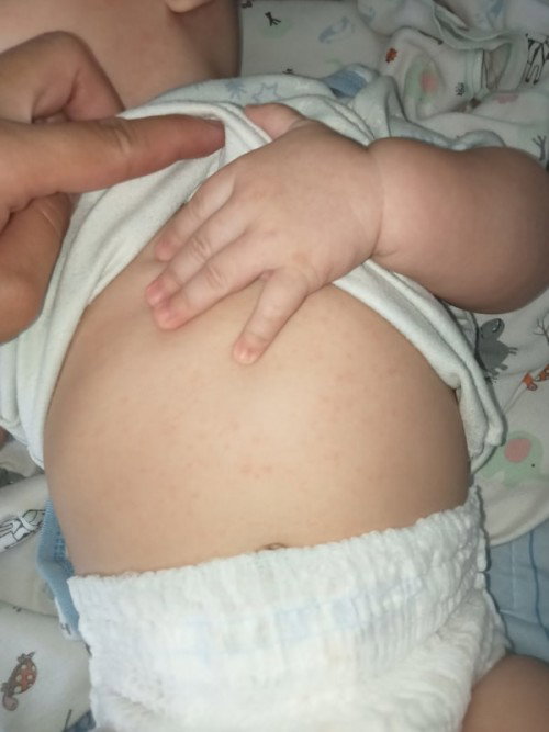 Bayi 5 bulan bintik merah
