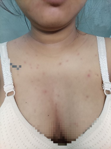 สิวขึ้นตามตัว