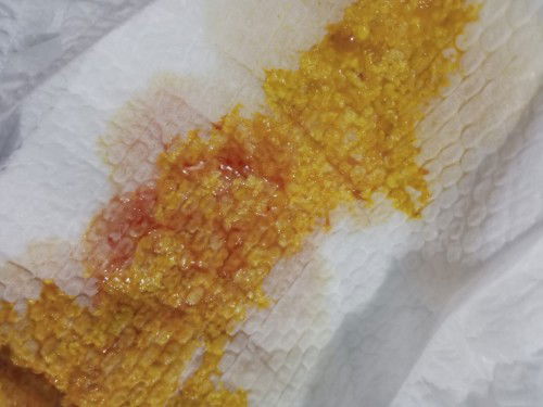 BAB BERLENDIR & BERDARAH BAYI 2 BULAN