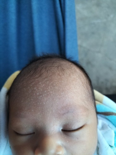 ลูกได้10วันแล้ว มีตุ่มใสๆ ขึ้นบนหัว
ลูกๆบ้านไหนเป็นบ้าง มีวิธีแก้ยังไงบ้างค่ะ