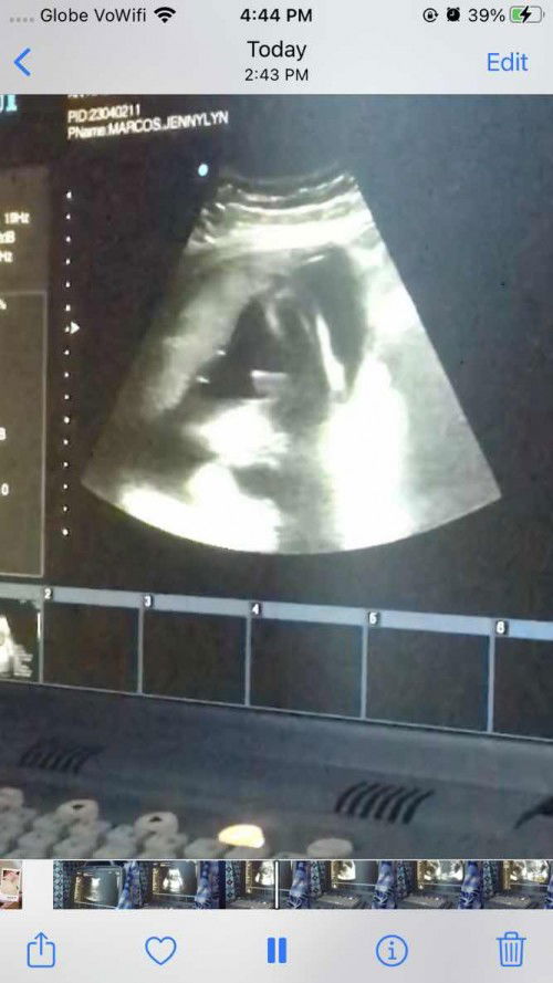 Pelvic utz. Is it a girl or boy?