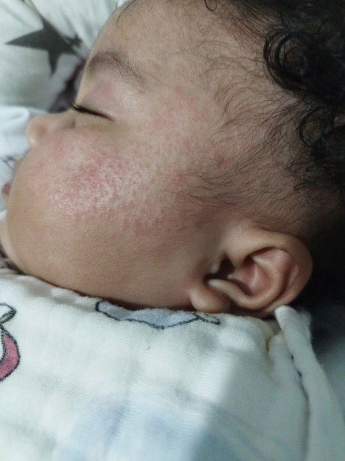Prickly heat. Ano po gamot dito para sa 4-month old baby? Do I need to bathe her twice a day? Thanks