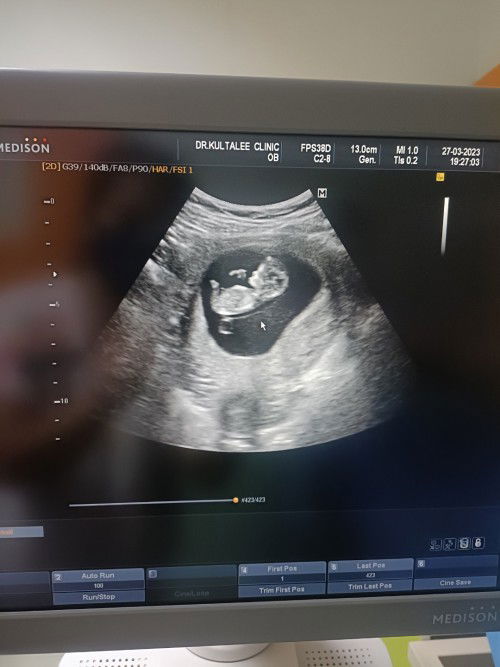 จุ๊ดจู๋หรือสายสะดือ😂😂