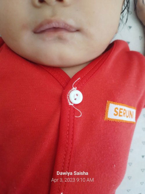 Bercak putih pada bayi