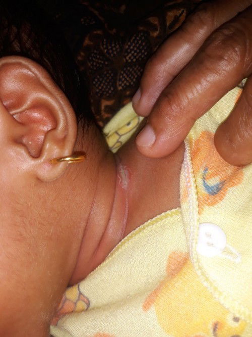 Luka di lipatan leher bayi