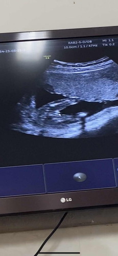 แม่ๆช่วยดูหน่อยคะ ซาวด์ดูเพศตอน16w3d หมอยืนยันว่าผู้หญิง แม่ๆว่า ผญ-ผช คะ👶🏻😂🥰
