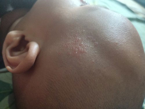 Muncul bintik bintik di kepala