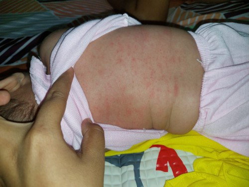 Badan bayi merah2