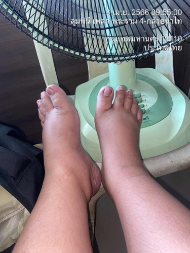 แม่บ้านไหน เท้าบวมมากตอน6เดือนบ้างมั้ยคะ อาการนี้น่ากลัวมากมั้ย