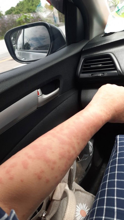 Bintik dan bentol merah di badan