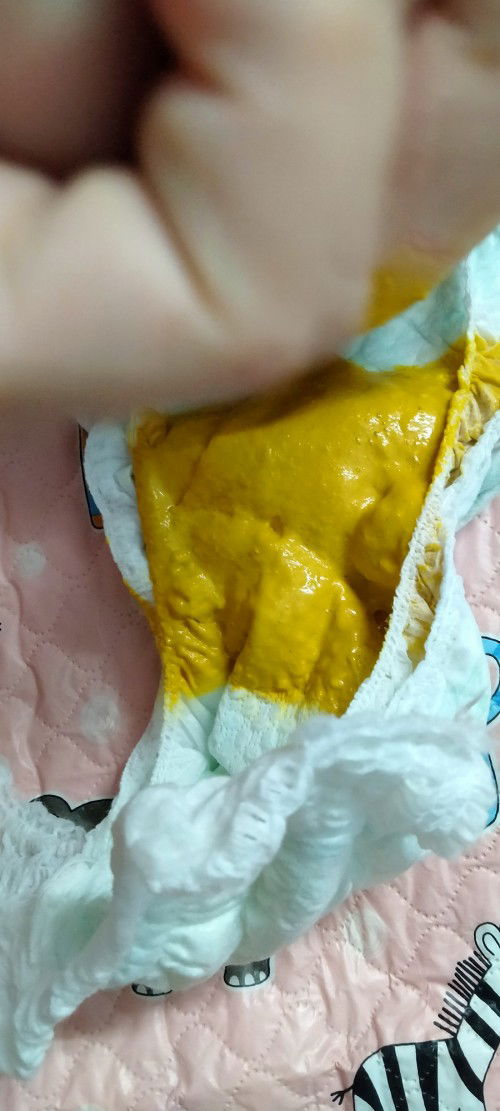 Các mom cho e hỏiBé nhà 2 tháng rưỡi hôm nay đi phân như nàycó phải tiêu chảy ko ạ hay là phân thườg