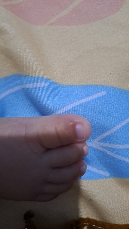 Kaki bayi berisi cairan