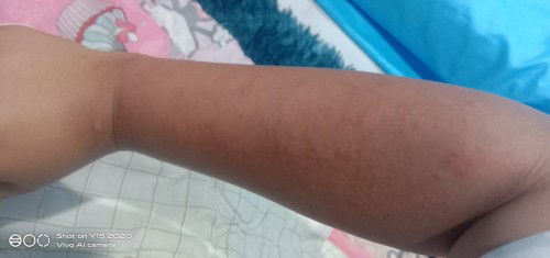 ขึ้นเม้ดแดงๆเต็มแขน