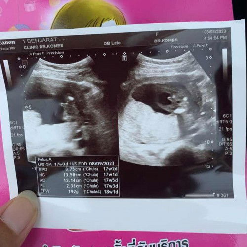 ใบอัลตร้าซาว