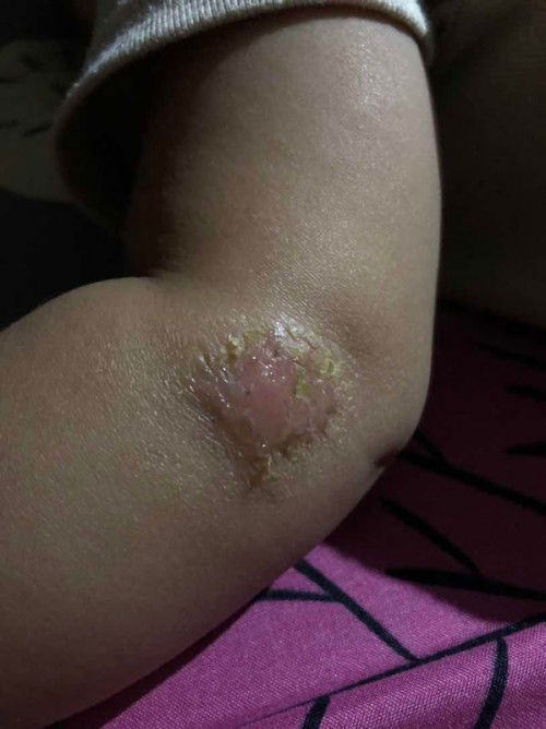 Luka pada siku anak 1 tahun