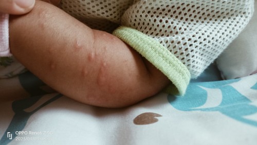 Baby 2 bulan naik bintik2 merah dekat tangan,kaki dan badan..mcm mn nk hilangkan?