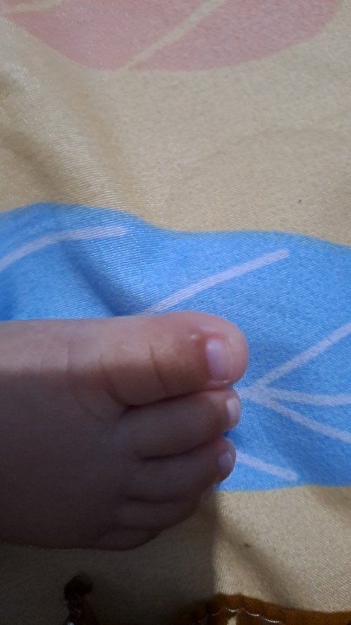 Kaki bayi berisi cairan