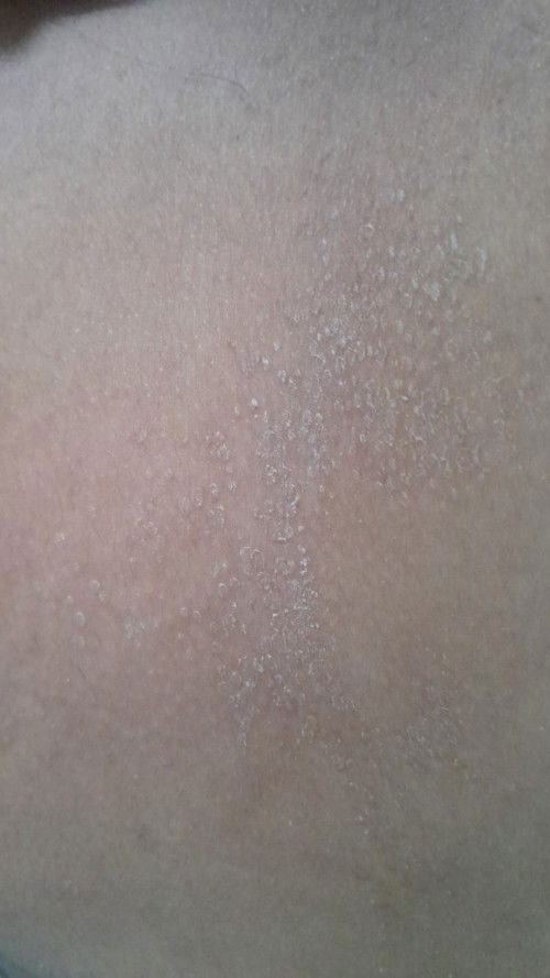 Gatal gatal pada badan saat hamil 3bulan