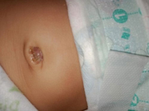 Bun mau tanya tolong ya Bun infonya.
Pusat anak saya basah terus airnya itu bau bun