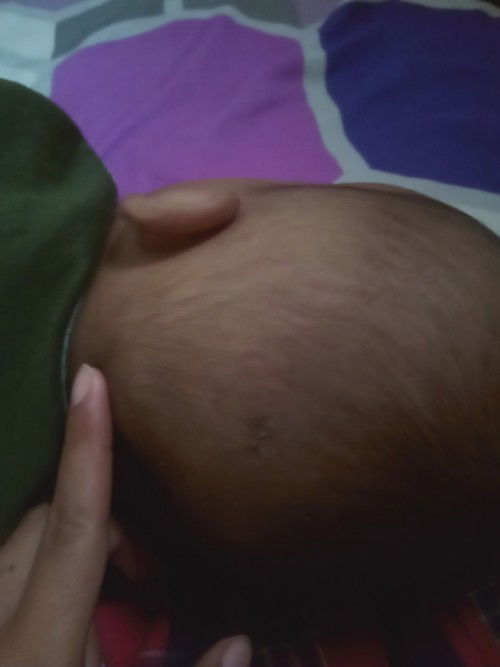 Benjolan kecil dibelakang kepala