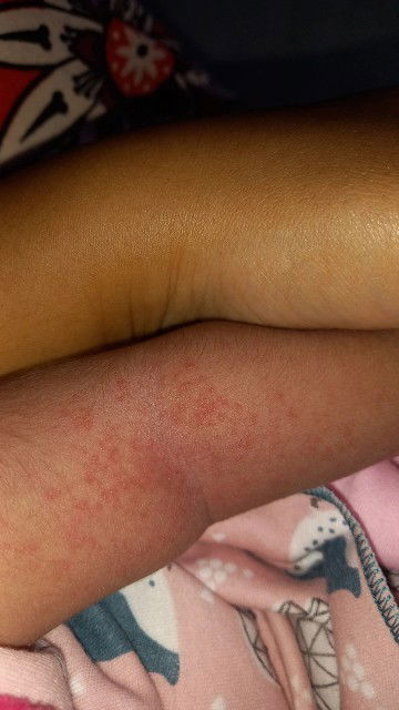 Tangan bintik² merah pada bayi