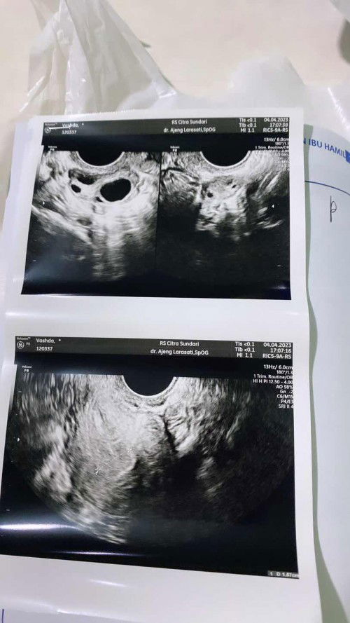 Hasil usg 3w6d